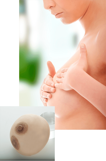 乳輪乳頭カモフラージュは乳房再建の仕上げ